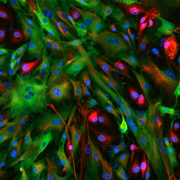 Organotypic Peritoneal Tissue Model, Manual Mode, 10x, DAPI, Calretinin Alexa-Fluor 488, Vimentin Alexa-Fluor 594, Cell Tracker Deep Red, High-Grade Serous Ovarian Cancer cells adhering to and disrupting a confluent mesothelial monolayer.  Image captured with: Cytation 3